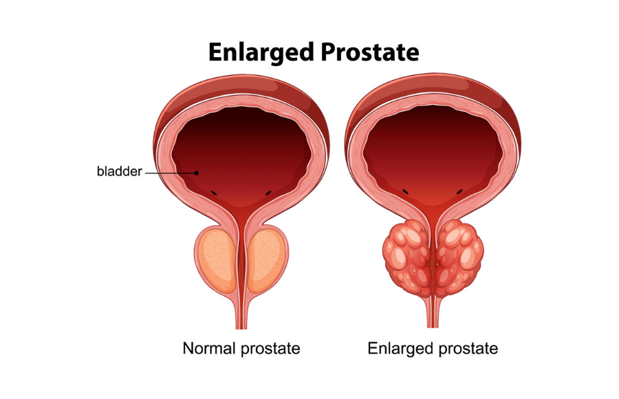 Illustration showing an enlarged prostate gland