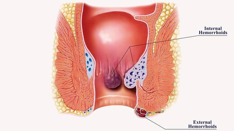 Medical illustration explaining internal and external hemorrhoids