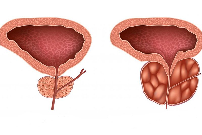 Diagram comparing a normal prostate and an enlarged prostate