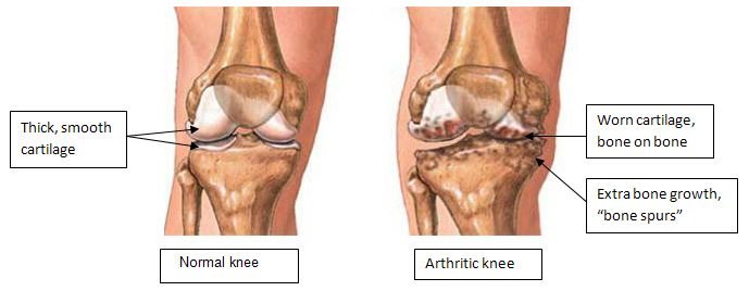 Illustration comparing a normal knee with an arthritic knee